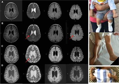 Biallelic COA7-Variants Leading to Developmental Regression With Progressive Spasticity and Brain Atrophy in a Chinese Patient